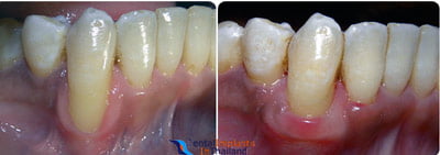 before-after-gum-grafting-photos-jamies-bangkok