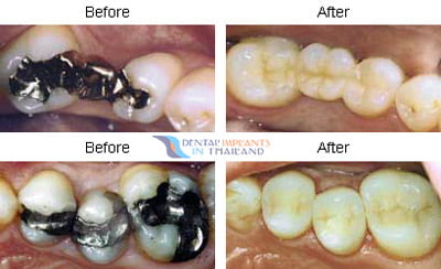 before-after-inlays-bangkok-dental