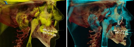 corrective-jaw-surgery-xray-before-after-thailand