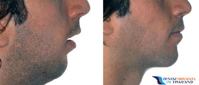 jaw-surgery-joey-before-after