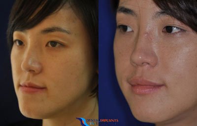 orthognathic-surgery-suu-before-and-after-prices