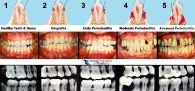 receding-gums-diseases-stages