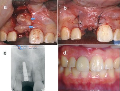 allogeneic-bone-grafting-thailand