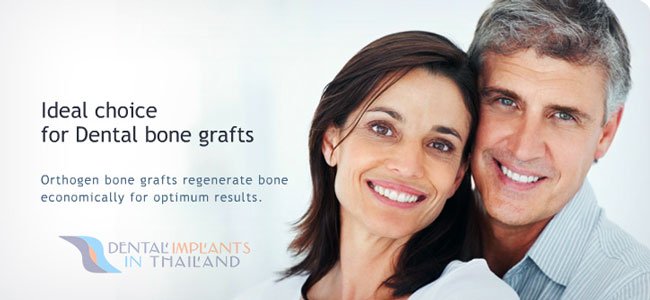 Autogenous Bone Grafting to Reverse Bone Loss