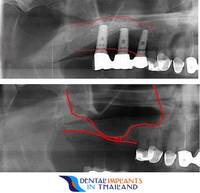 before-after-dental-bone-grafts-bangkok