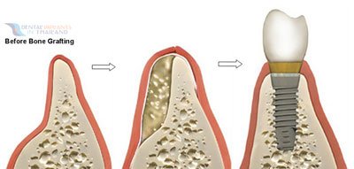 before-bone-grafting