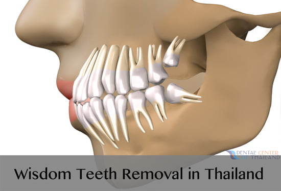 wisdom-teeth-extraction-thailand