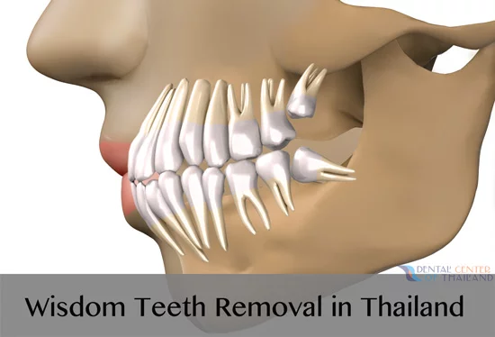 wisdom-teeth-extraction-thailand