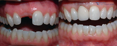 Mouth-Restoration-surgery-thailand-Before-After