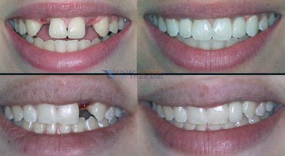 full-Mouth-Restoration-thailand-Before-After