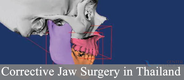 Orthognathic-corrective-jaw-surgery-thailand
